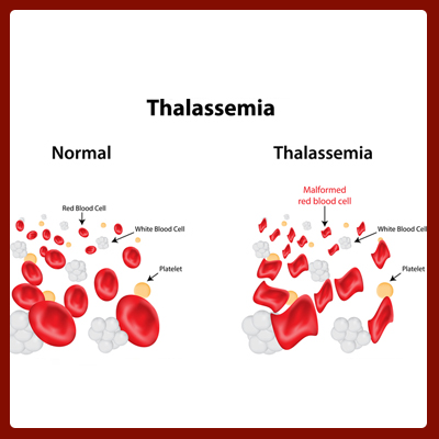 thalassemia